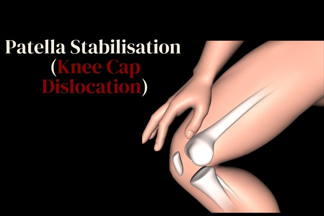 Patella Stabilisation (Knee Cap Dislocation) Treatment in Hyderabad