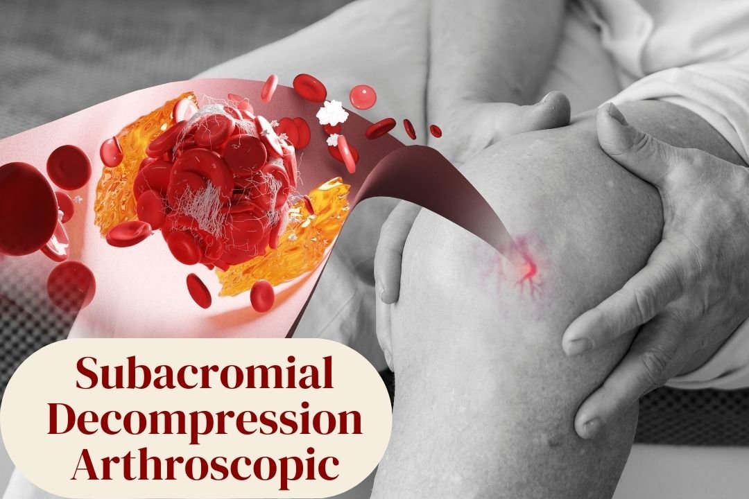 Subacromial Decompression Arthroscopic in Hyderabad