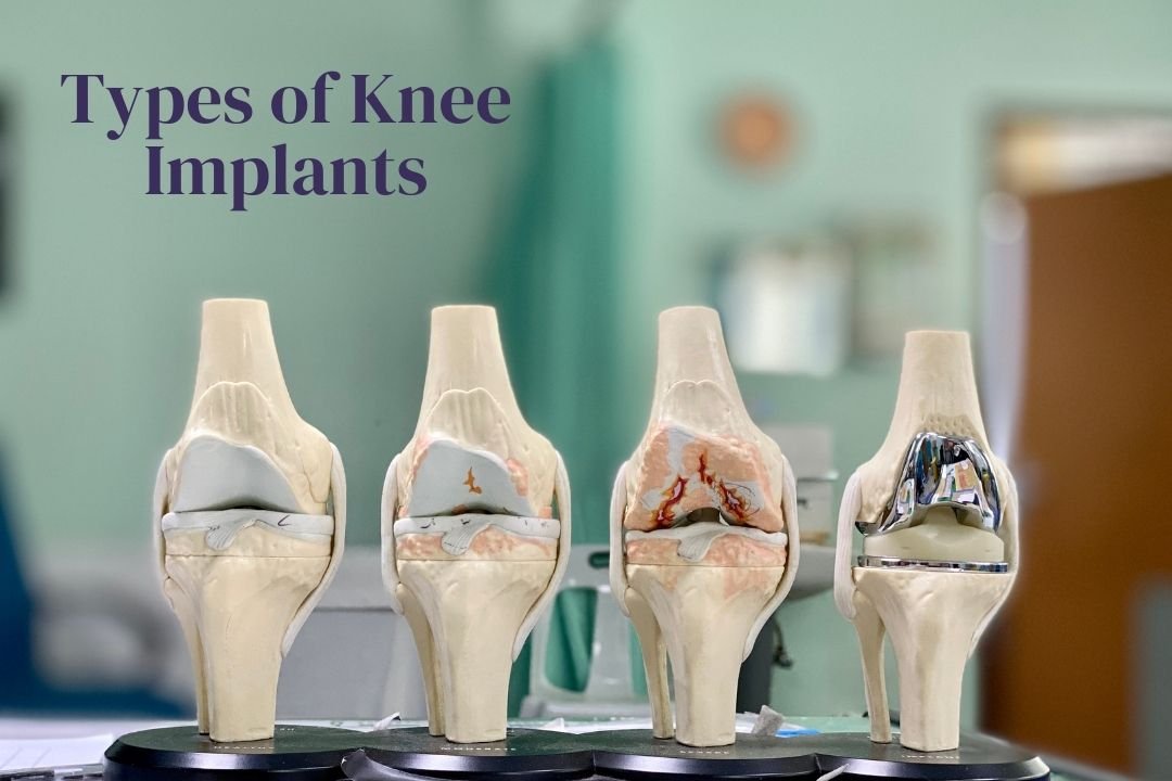 Types Of Knee Implants